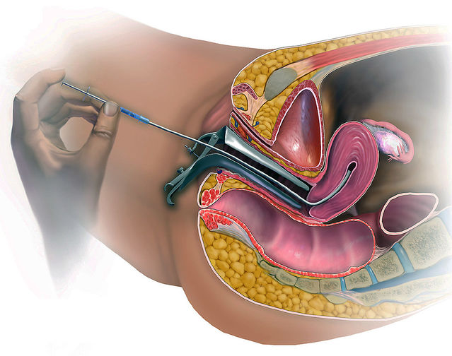 christi holder add Artificial Insemination Porn photo