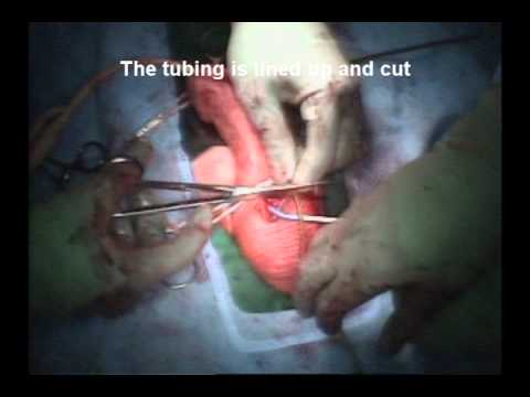 chelsea dolan add Grandpa Penile Implant Videos photo