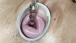 carol blount add Cervix Insertion Porn photo