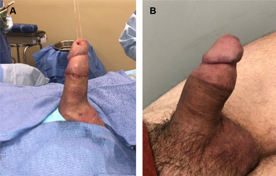 amit mayekar add Penile Implant Porn photo