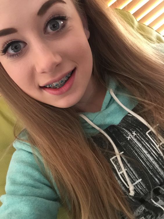 beth fischbein add Teens With Braces Naked photo